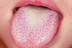 吃麻舌头瓜的症状,揭秘奇特口感背后的神秘症状