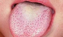 吃小瓜舌头刺痛,吃小瓜为何引发刺痛之谜